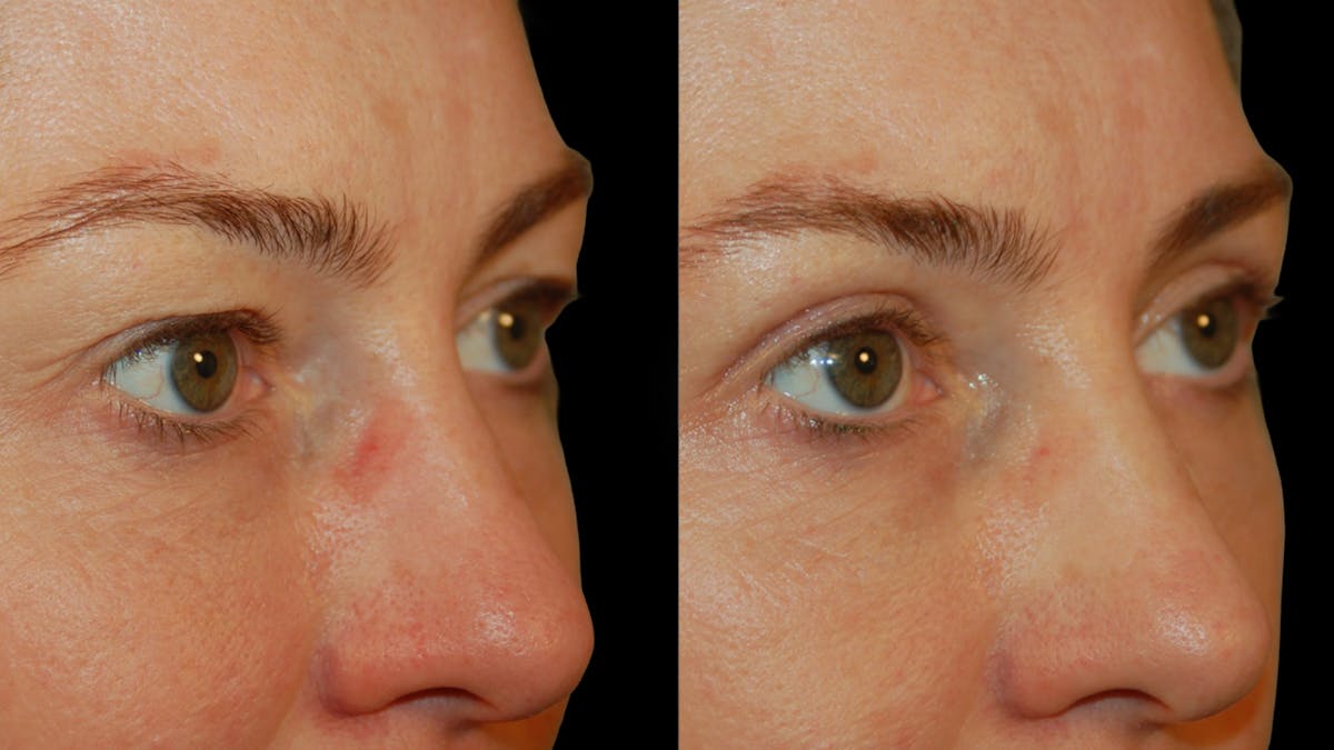 Upper Eyelid Surgery Before & After Gallery - Patient 419026 - Image 3