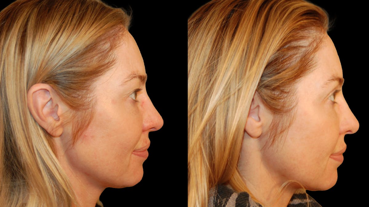Upper Eyelid Surgery Before & After Gallery - Patient 419026 - Image 4