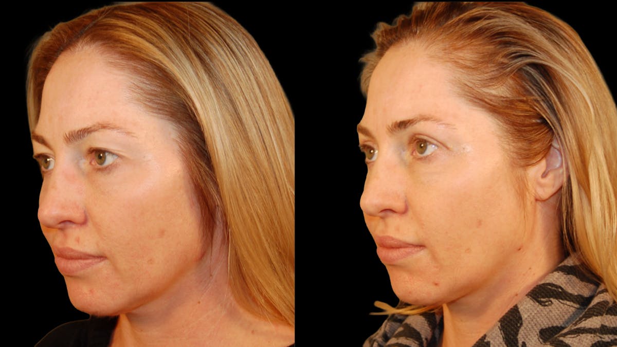 Upper Eyelid Surgery Before & After Gallery - Patient 419026 - Image 5