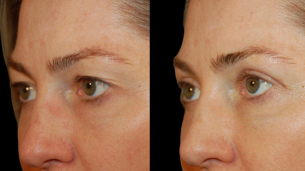 Upper Eyelid Surgery Before & After Gallery - Patient 419026 - Image 6