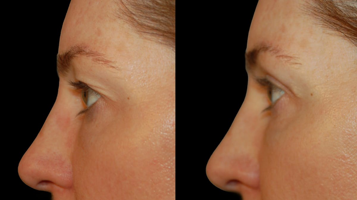 Upper Eyelid Surgery Before & After Gallery - Patient 419026 - Image 8