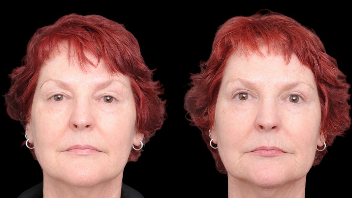 Upper Eyelid Surgery Before & After Gallery - Patient 428919 - Image 1