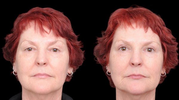 Upper Eyelid Surgery Before & After Gallery - Patient 428919 - Image 1