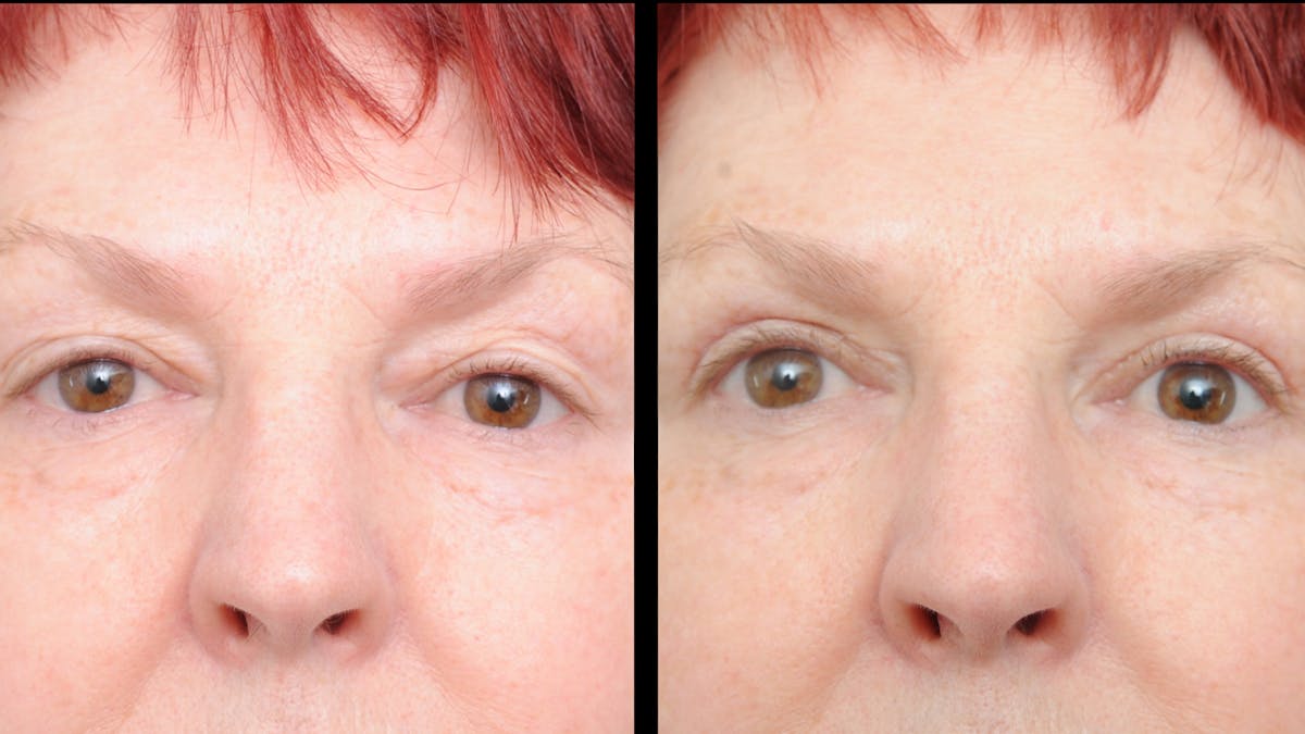 Upper Eyelid Surgery Before & After Gallery - Patient 428919 - Image 4