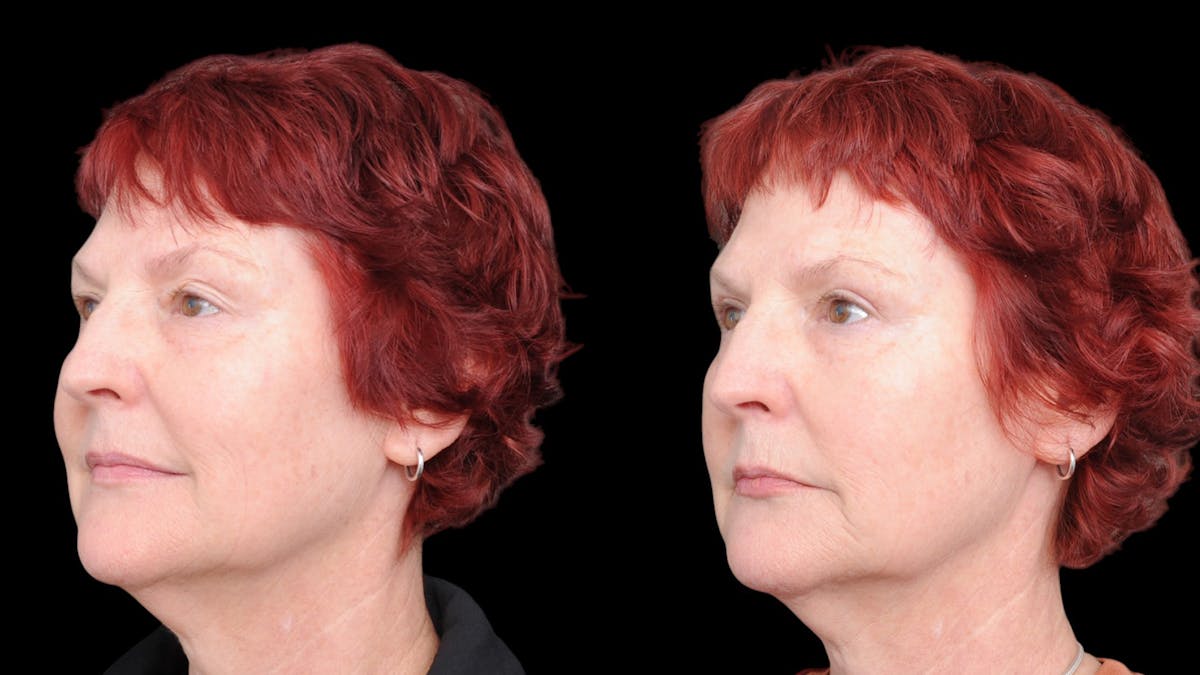 Upper Eyelid Surgery Before & After Gallery - Patient 428919 - Image 2