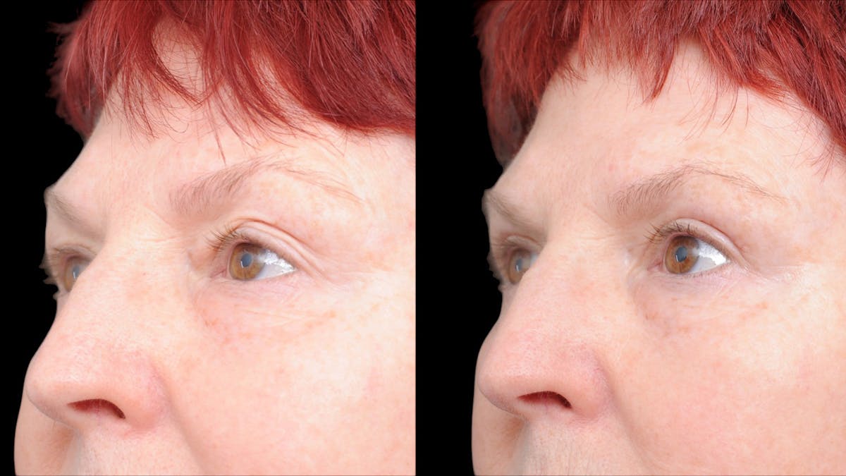Upper Eyelid Surgery Before & After Gallery - Patient 428919 - Image 5