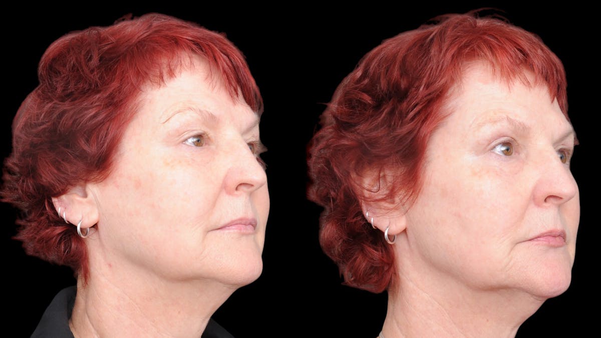 Upper Eyelid Surgery Before & After Gallery - Patient 428919 - Image 3