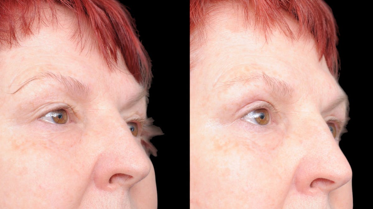Upper Eyelid Surgery Before & After Gallery - Patient 428919 - Image 6