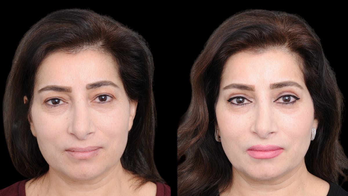 Upper Eyelid Surgery Before & After Gallery - Patient 102172 - Image 1