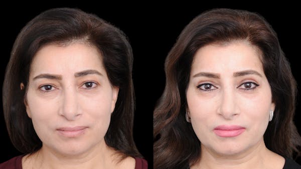 Upper Eyelid Surgery Before & After Gallery - Patient 102172 - Image 1