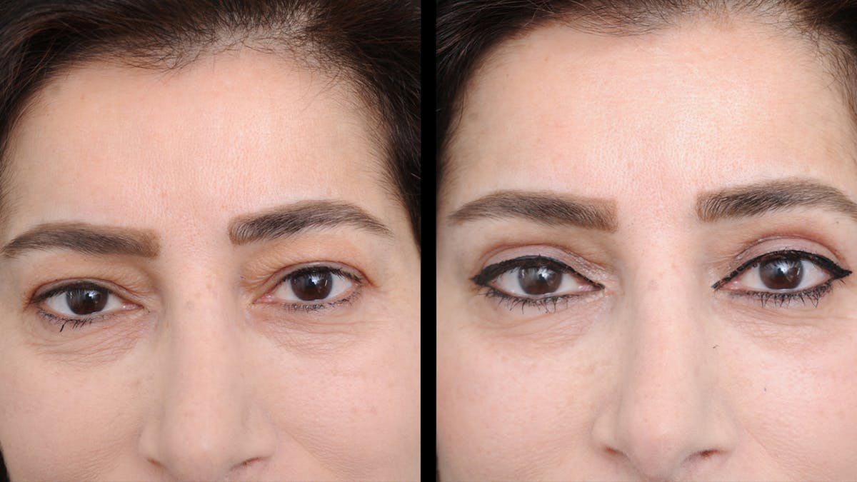 Upper Eyelid Surgery Before & After Gallery - Patient 102172 - Image 2
