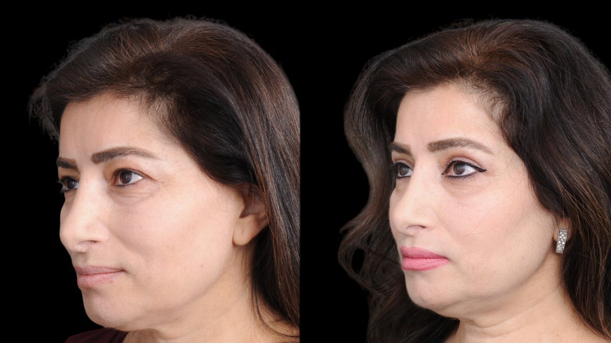 Upper Eyelid Surgery Before & After Gallery - Patient 102172 - Image 3