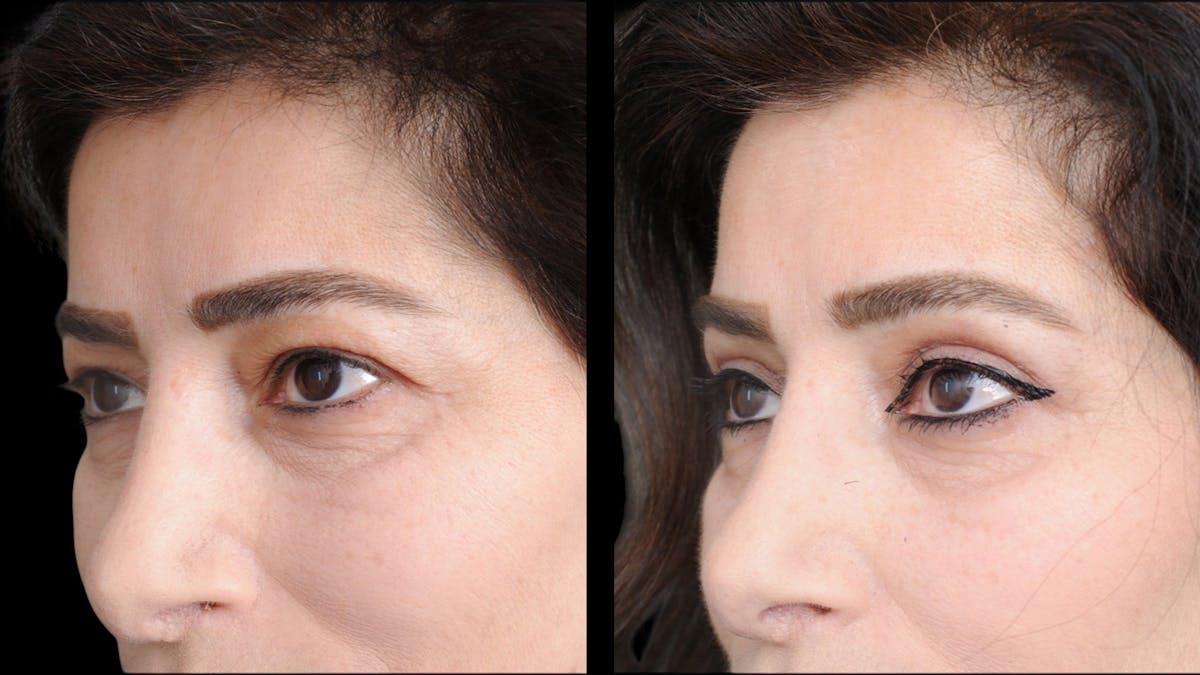Upper Eyelid Surgery Before & After Gallery - Patient 102172 - Image 4