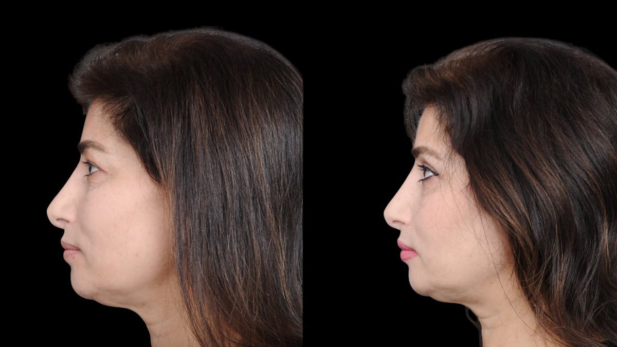 Upper Eyelid Surgery Before & After Gallery - Patient 102172 - Image 5