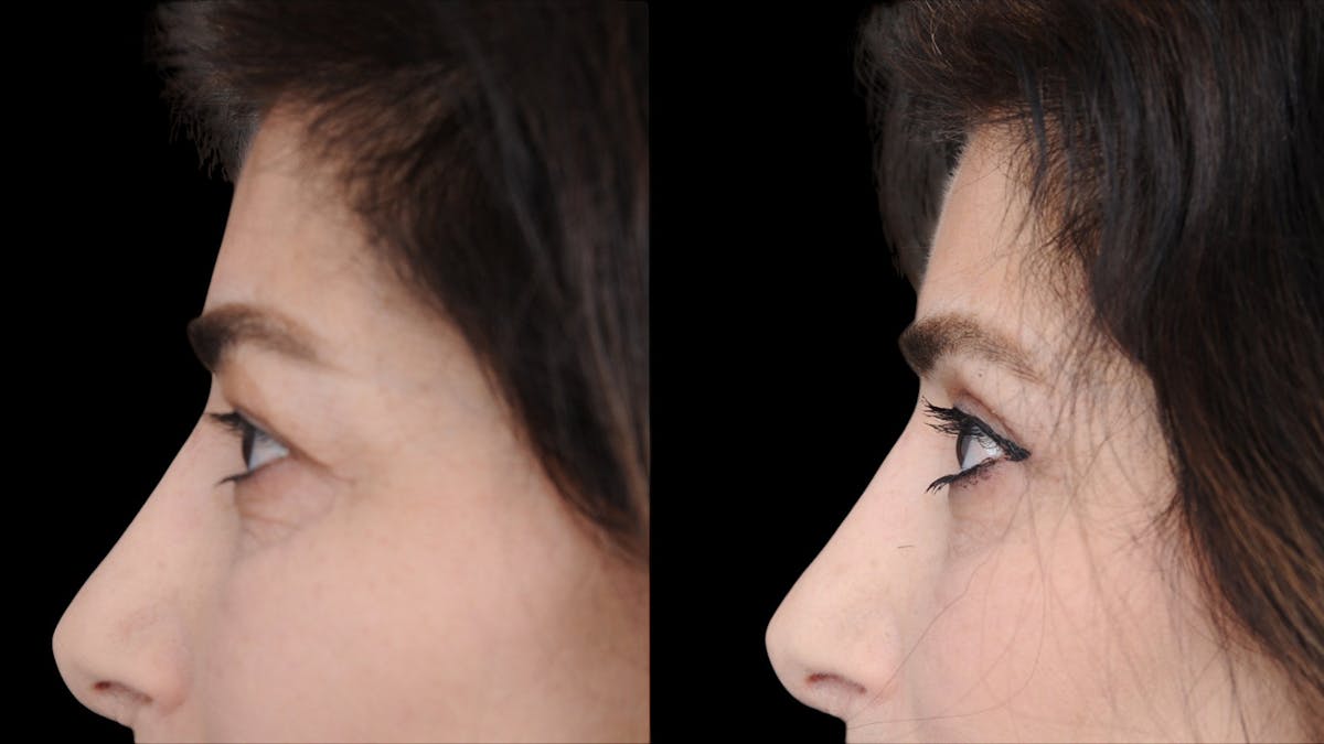 Upper Eyelid Surgery Before & After Gallery - Patient 102172 - Image 6