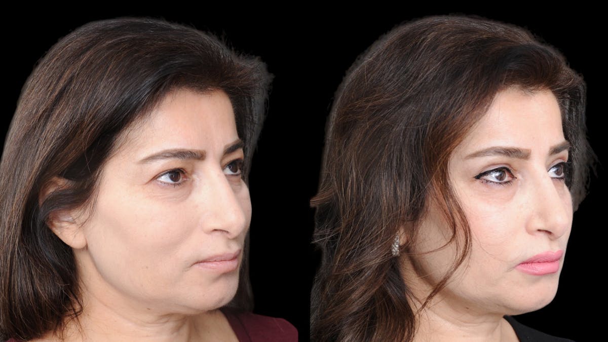 Upper Eyelid Surgery Before & After Gallery - Patient 102172 - Image 7