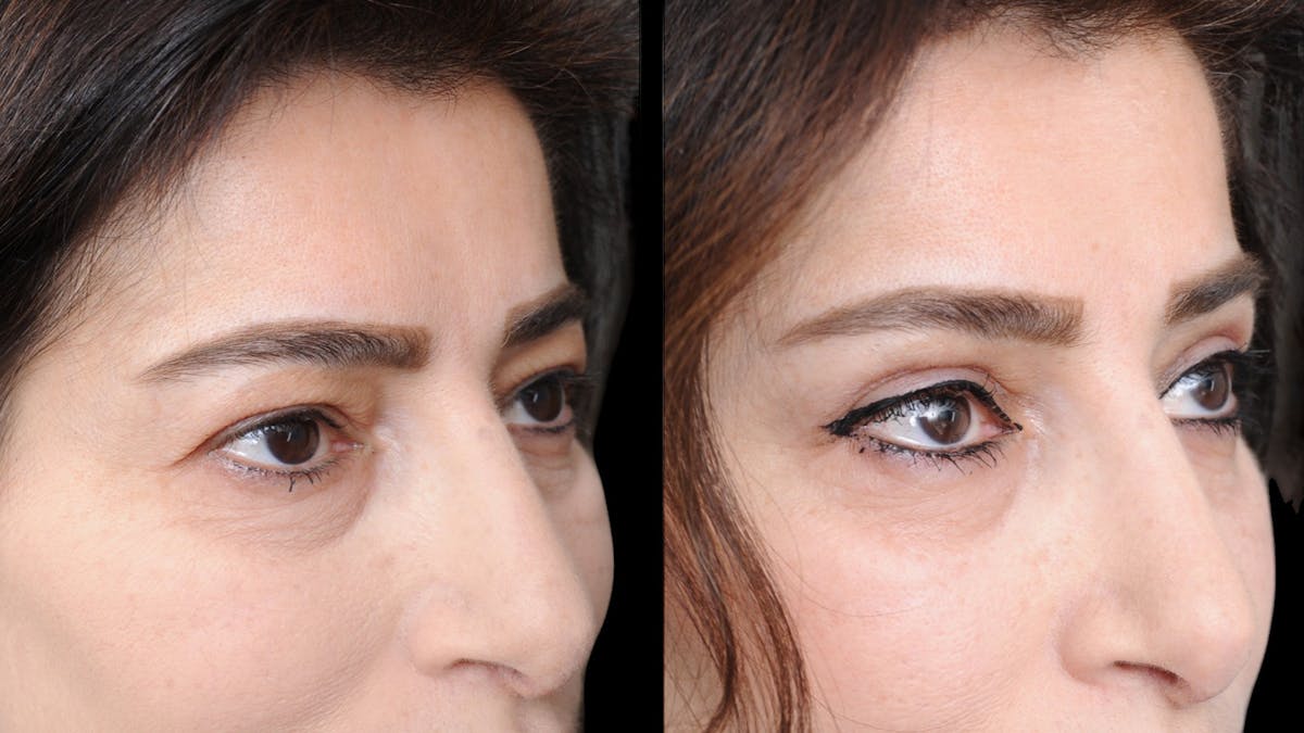 Upper Eyelid Surgery Before & After Gallery - Patient 102172 - Image 8