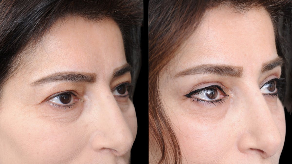 Upper Eyelid Surgery Before & After Gallery - Patient 102172 - Image 9