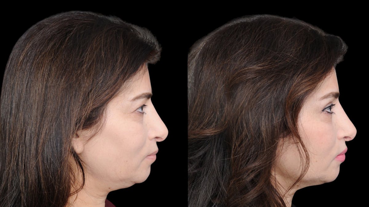 Upper Eyelid Surgery Before & After Gallery - Patient 102172 - Image 10