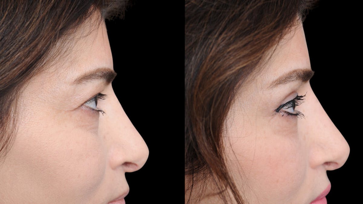 Upper Eyelid Surgery Before & After Gallery - Patient 102172 - Image 11