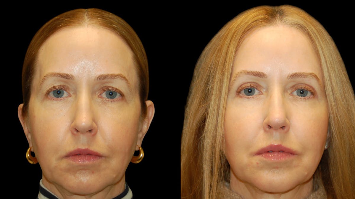 Upper Eyelid Surgery Before & After Gallery - Patient 572562 - Image 1