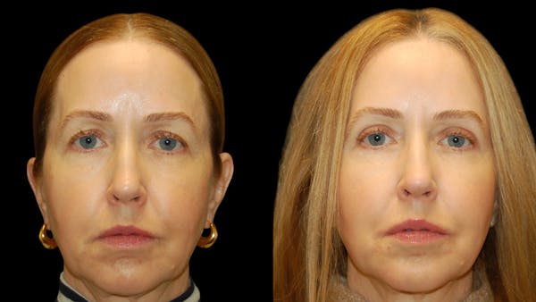 Upper Eyelid Surgery Before & After Gallery - Patient 572562 - Image 1
