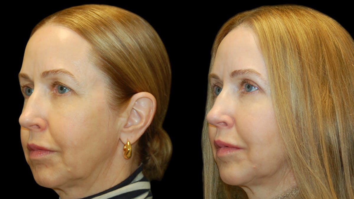Upper Eyelid Surgery Before & After Gallery - Patient 572562 - Image 2