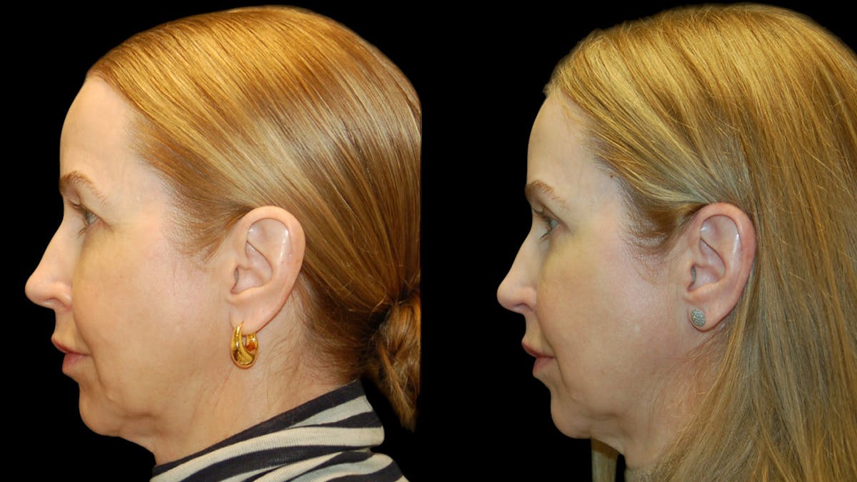 Upper Eyelid Surgery Before & After Gallery - Patient 572562 - Image 3