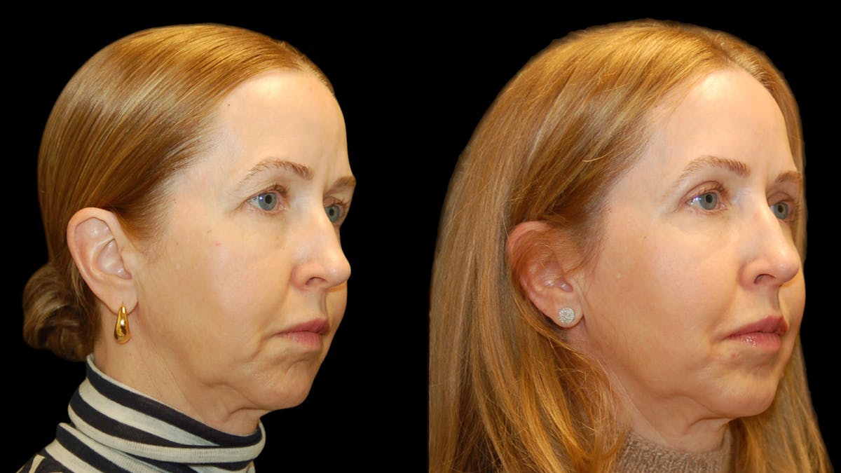 Upper Eyelid Surgery Before & After Gallery - Patient 572562 - Image 4
