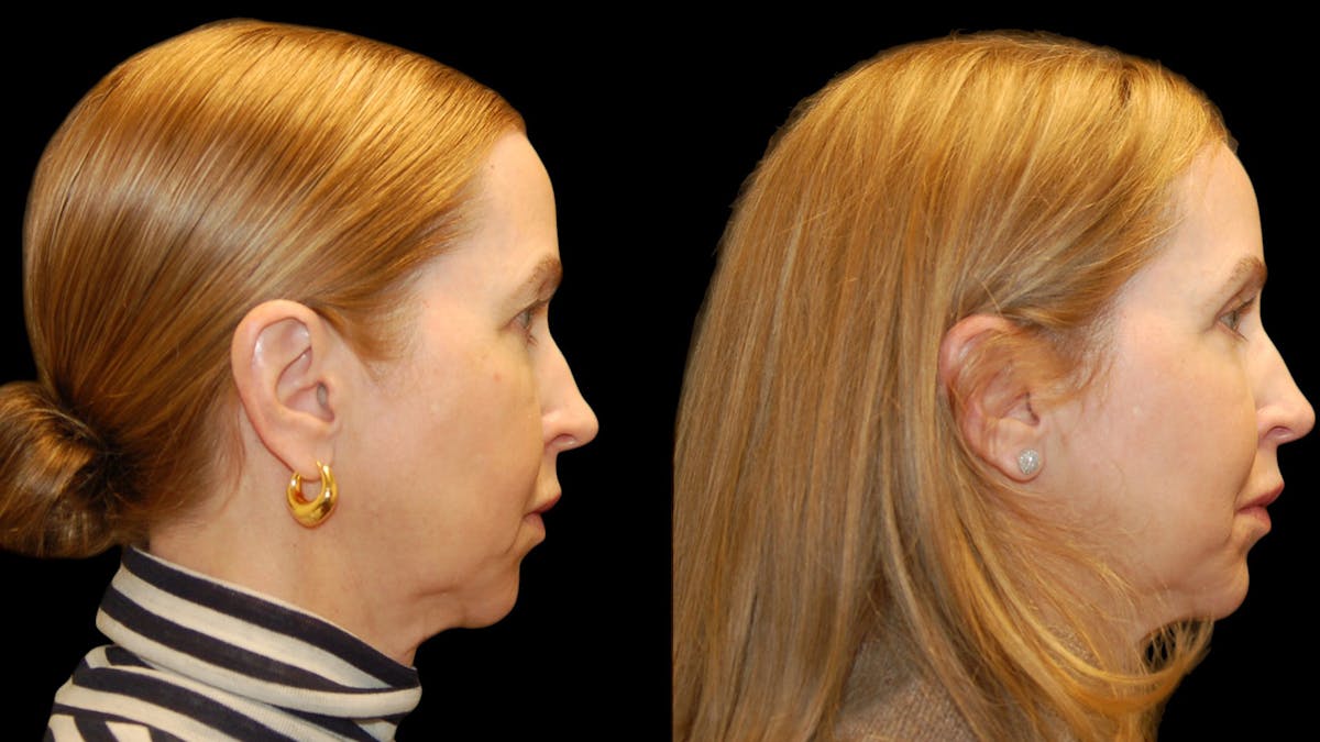 Upper Eyelid Surgery Before & After Gallery - Patient 572562 - Image 5