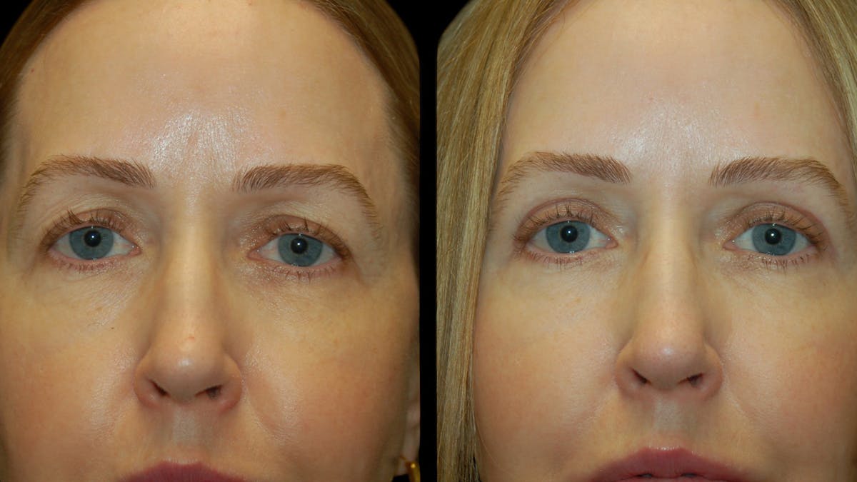 Upper Eyelid Surgery Before & After Gallery - Patient 572562 - Image 6