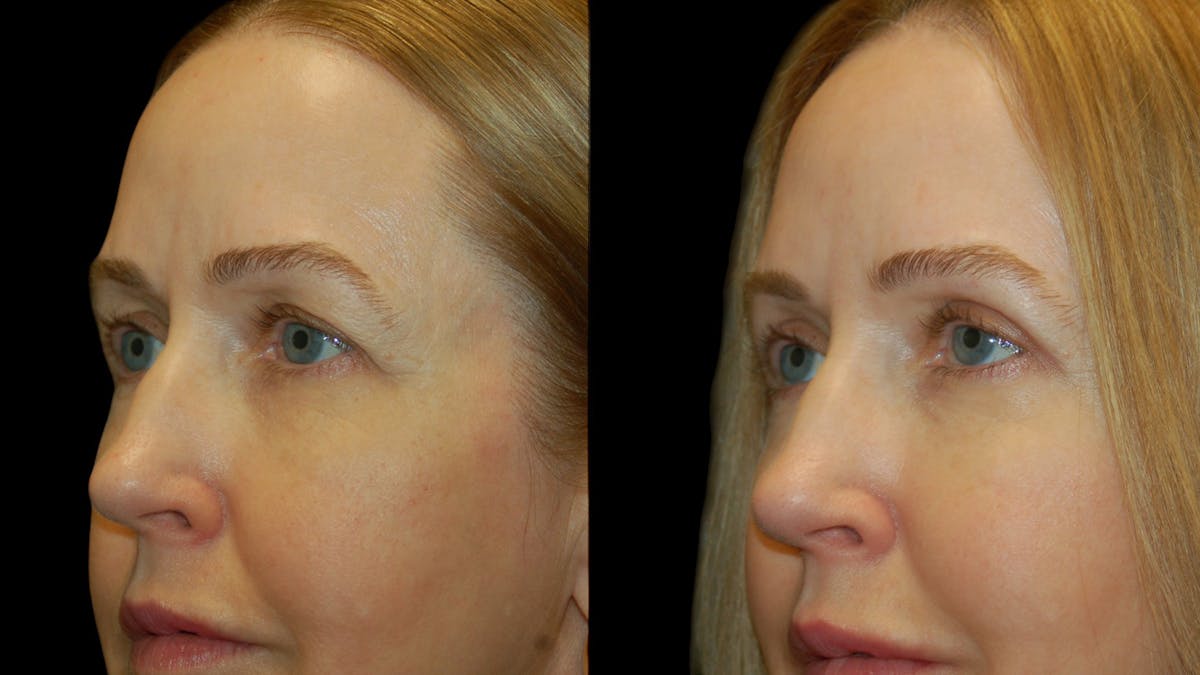 Upper Eyelid Surgery Before & After Gallery - Patient 572562 - Image 7