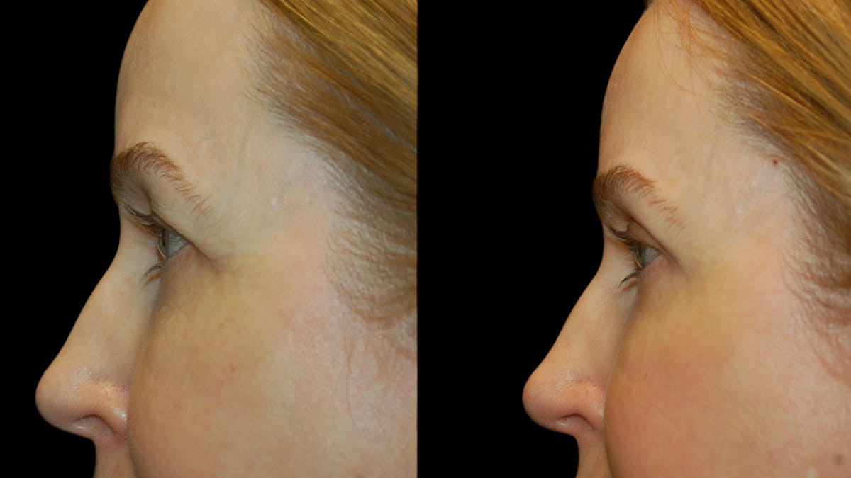 Upper Eyelid Surgery Before & After Gallery - Patient 572562 - Image 8
