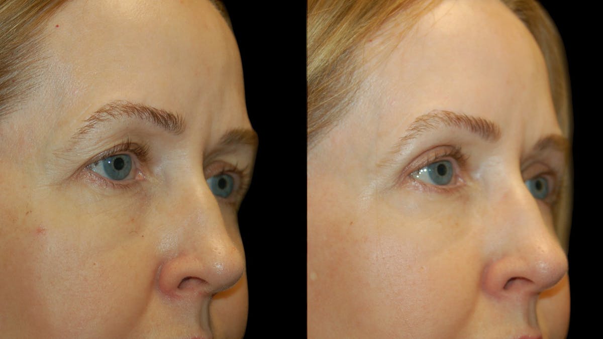 Upper Eyelid Surgery Before & After Gallery - Patient 572562 - Image 9