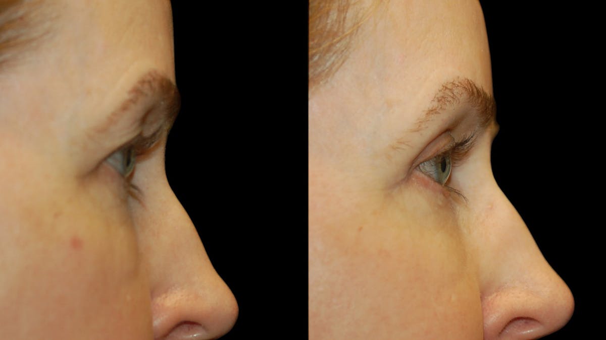 Upper Eyelid Surgery Before & After Gallery - Patient 572562 - Image 10