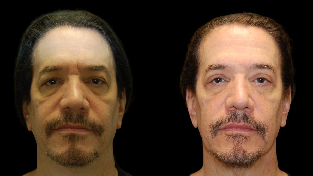 Upper Eyelid Surgery Before & After Gallery - Patient 928377 - Image 1