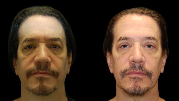 Upper Eyelid Surgery Before & After Gallery - Patient 928377 - Image 1