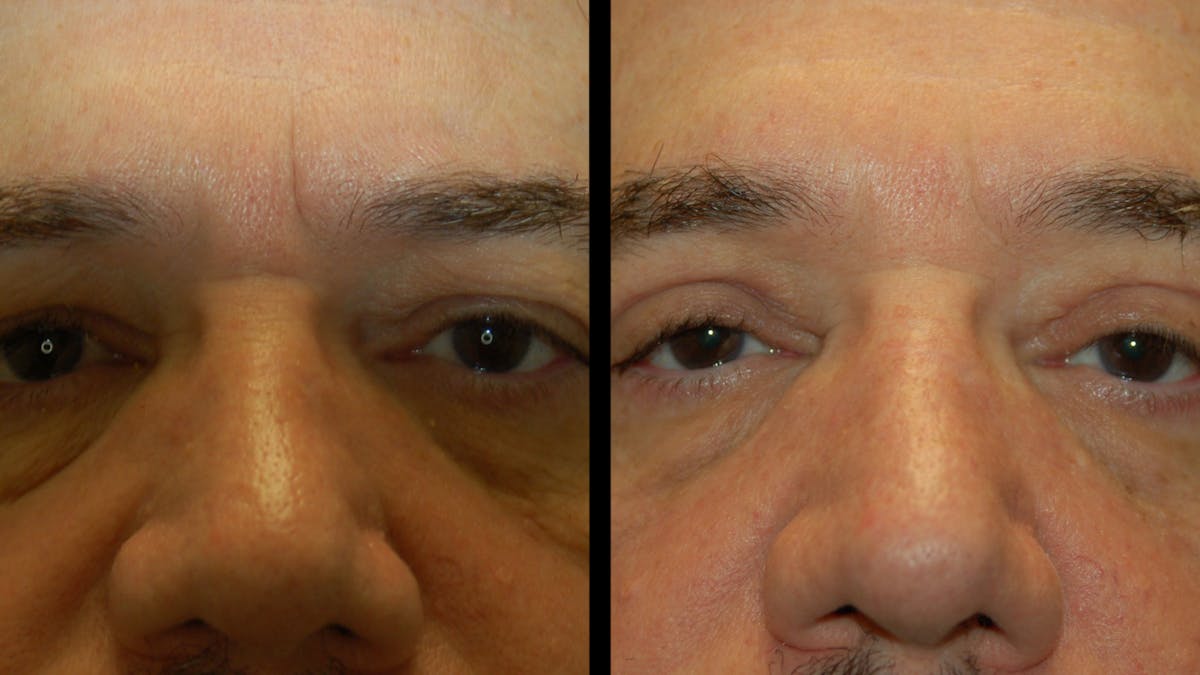 Upper Eyelid Surgery Before & After Gallery - Patient 928377 - Image 5