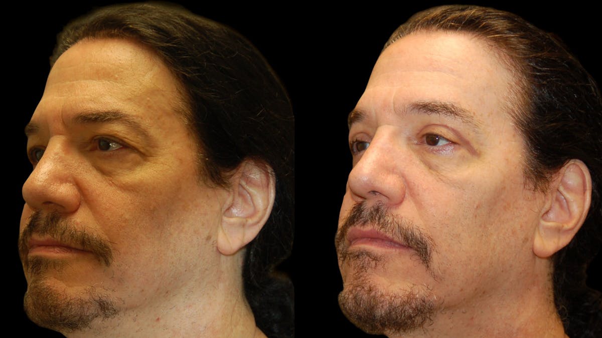 Upper Eyelid Surgery Before & After Gallery - Patient 928377 - Image 2