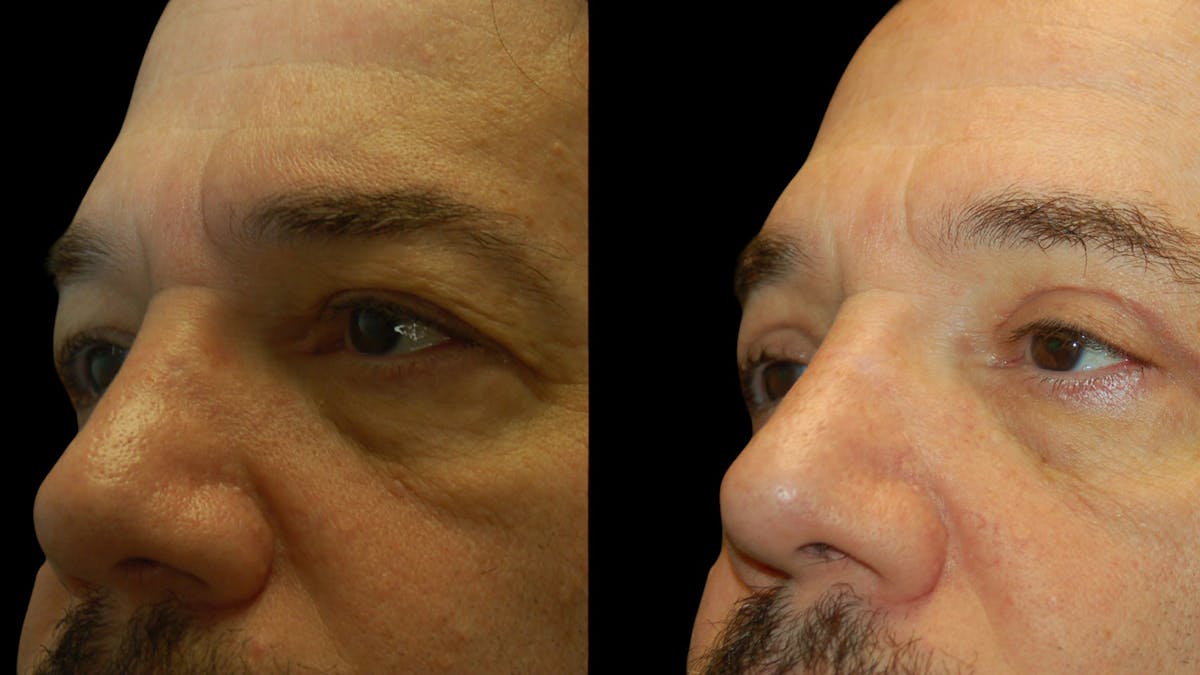 Upper Eyelid Surgery Before & After Gallery - Patient 928377 - Image 6