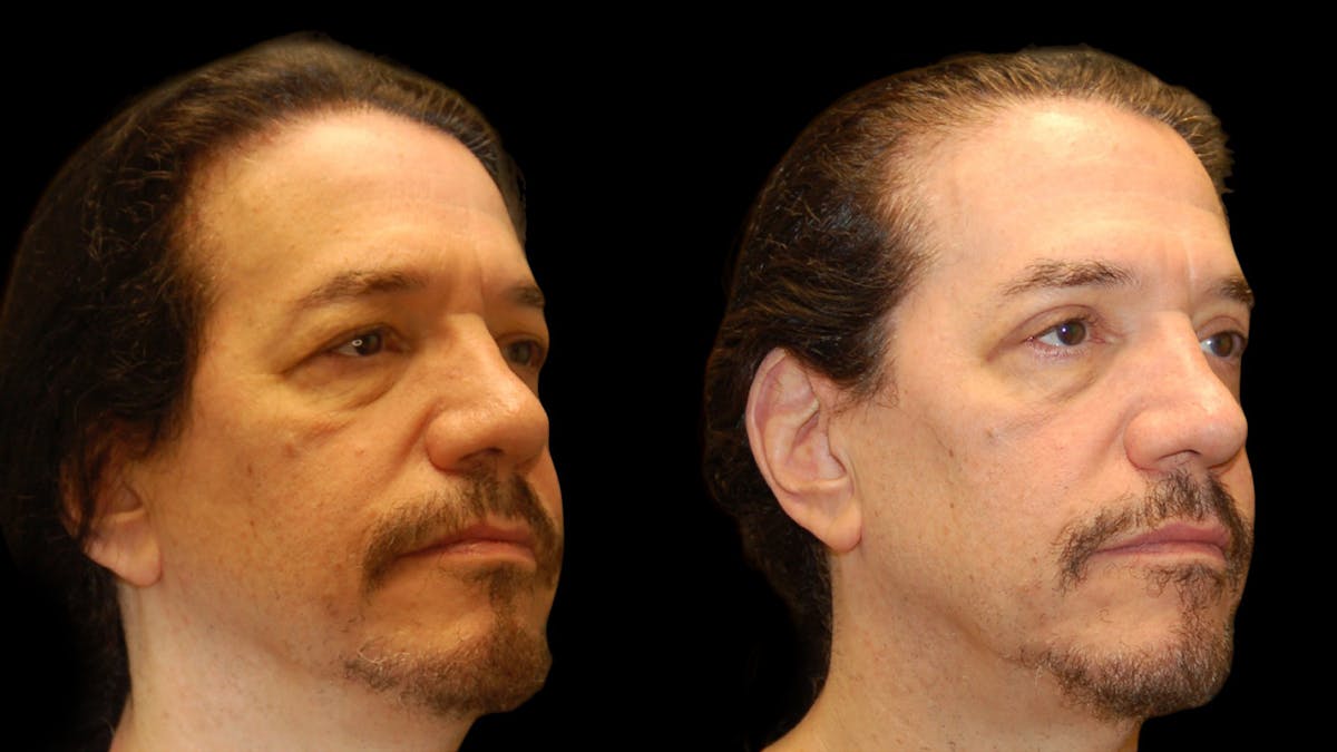 Upper Eyelid Surgery Before & After Gallery - Patient 928377 - Image 3