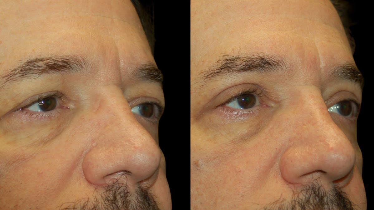 Upper Eyelid Surgery Before & After Gallery - Patient 928377 - Image 7