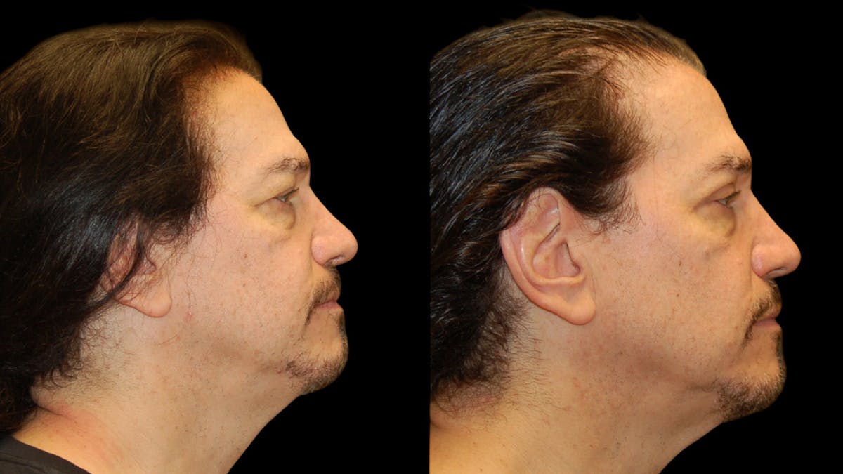 Upper Eyelid Surgery Before & After Gallery - Patient 928377 - Image 4