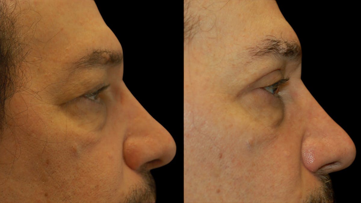 Upper Eyelid Surgery Before & After Gallery - Patient 928377 - Image 8