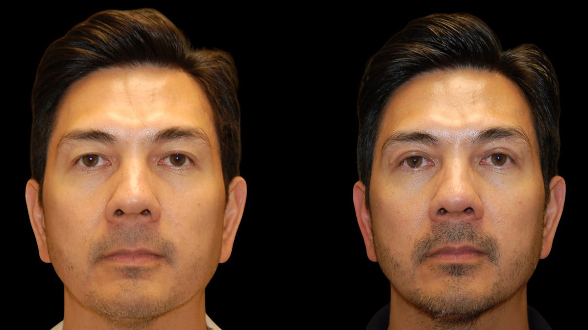 Upper Eyelid Surgery Before & After Gallery - Patient 182517 - Image 1