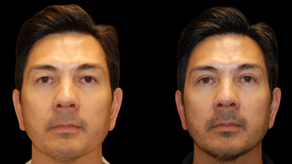 Upper Eyelid Surgery Before & After Gallery - Patient 182517 - Image 1