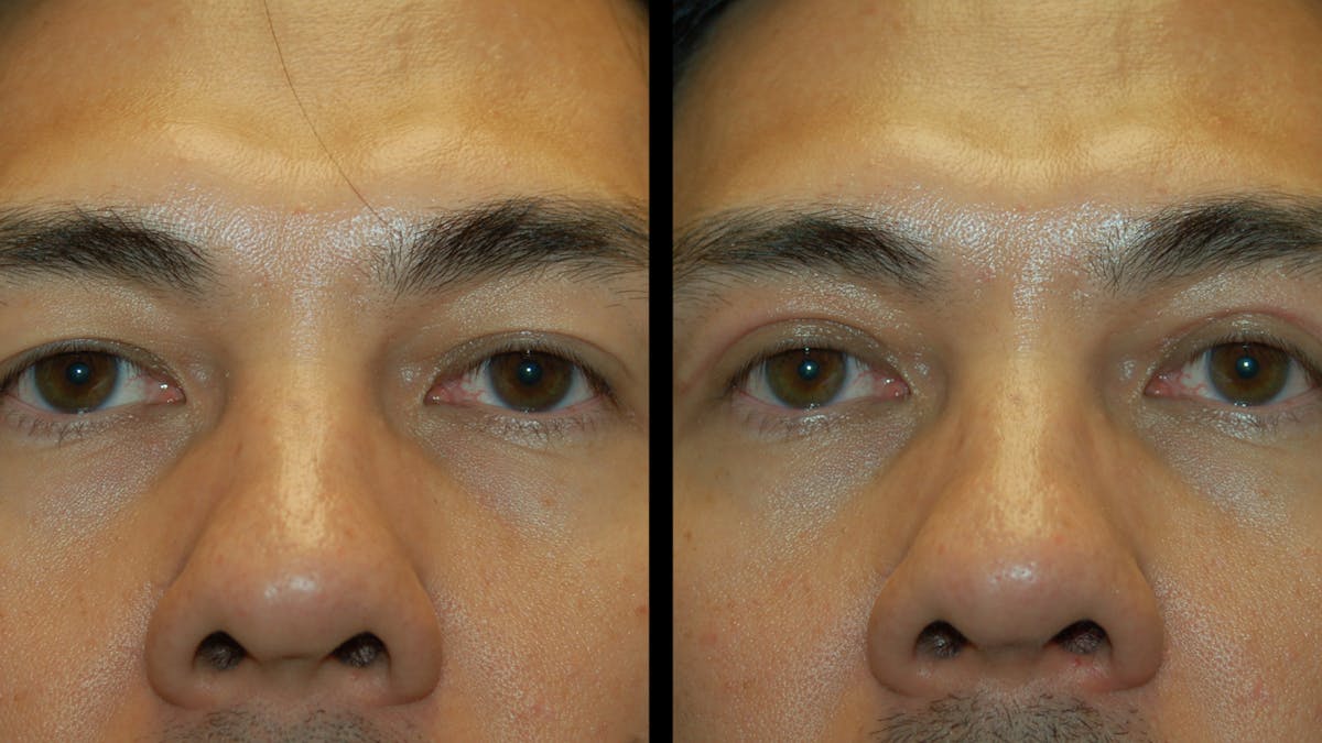 Upper Eyelid Surgery Before & After Gallery - Patient 182517 - Image 2