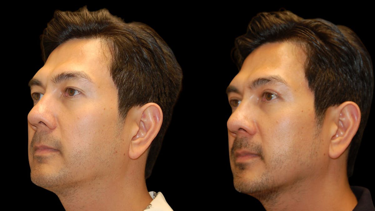 Upper Eyelid Surgery Before & After Gallery - Patient 182517 - Image 3