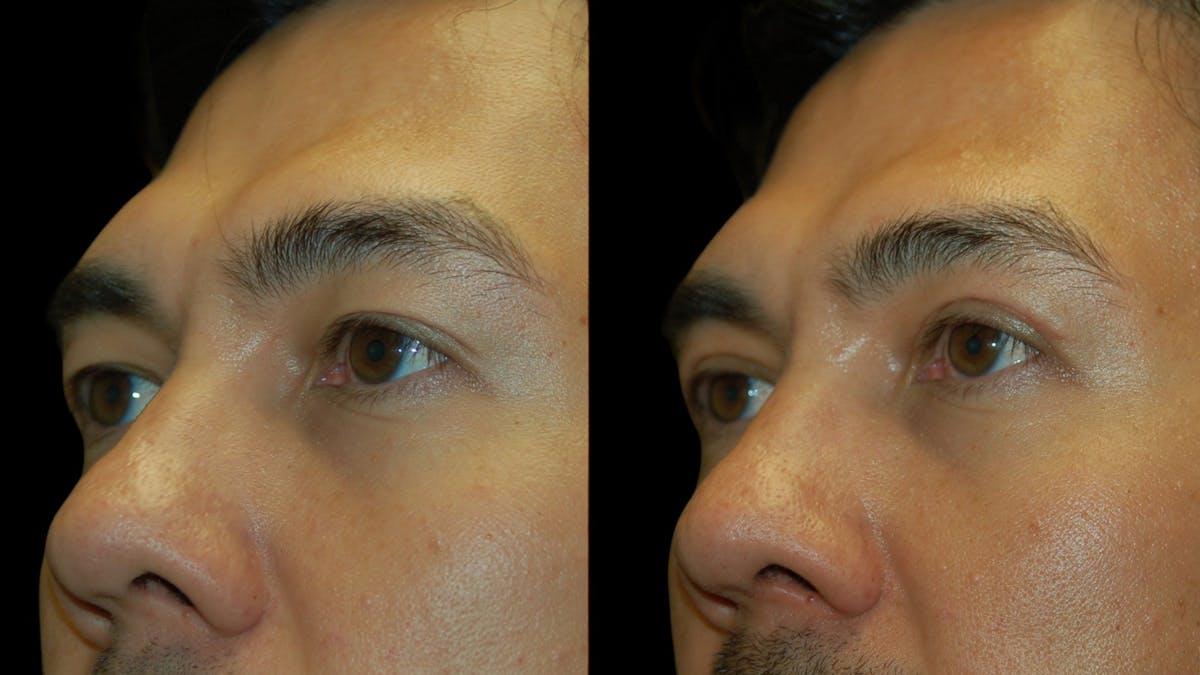 Upper Eyelid Surgery Before & After Gallery - Patient 182517 - Image 4