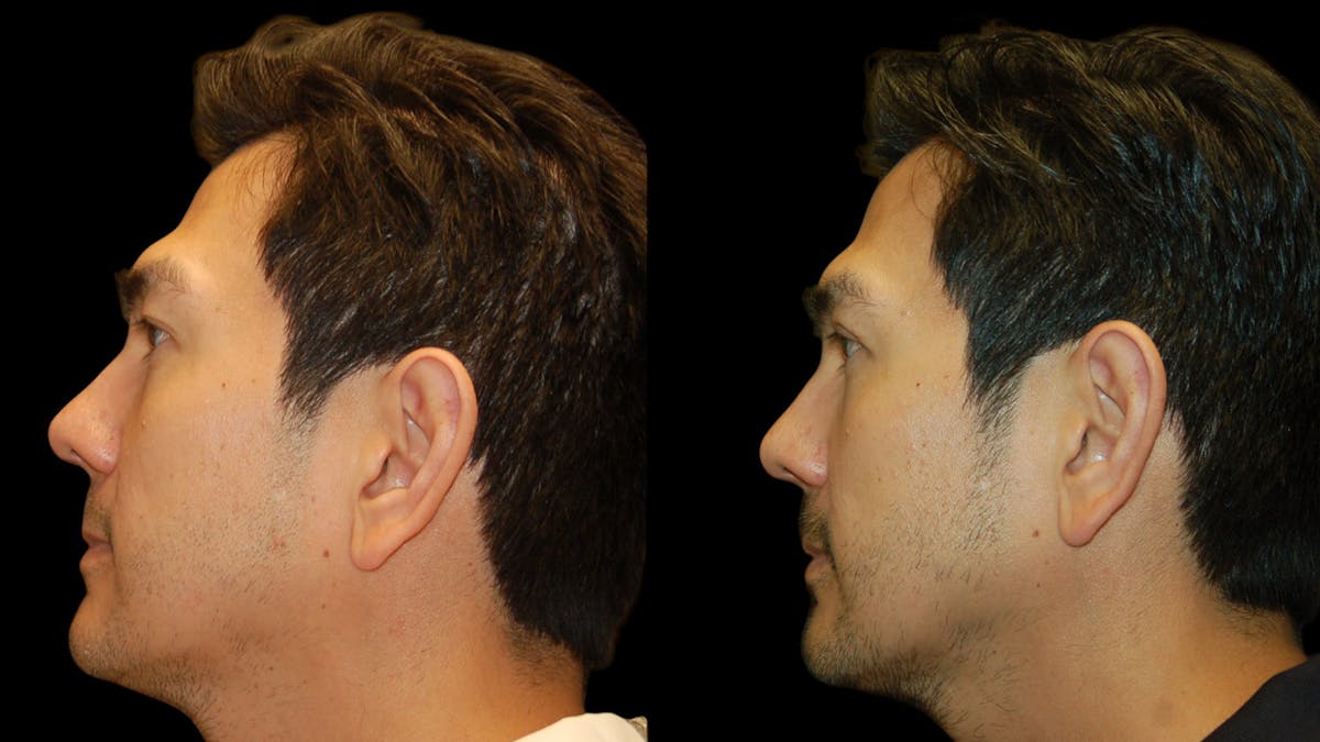 Upper Eyelid Surgery Before & After Gallery - Patient 182517 - Image 5